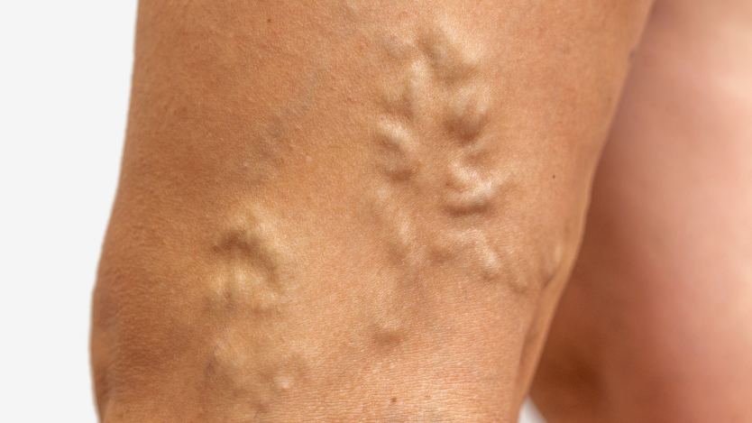 Complications of varicose veins