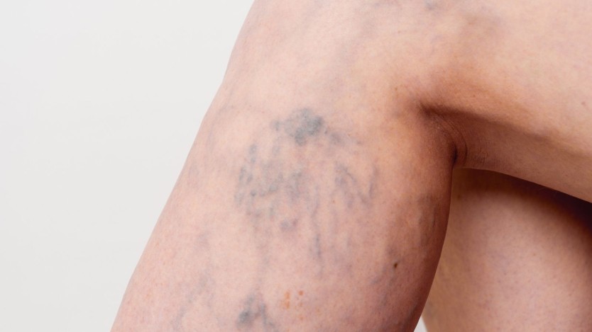 Varicose veins surgery