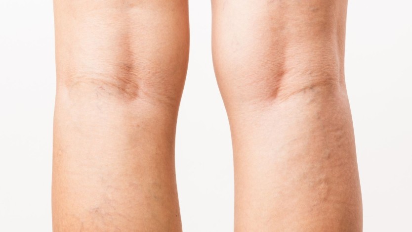 Varicose veins in both legs