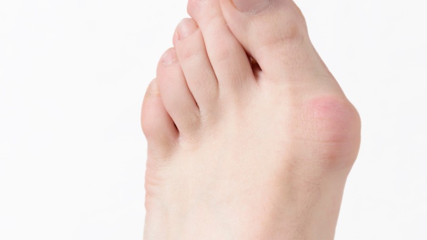 Why do bunions form?