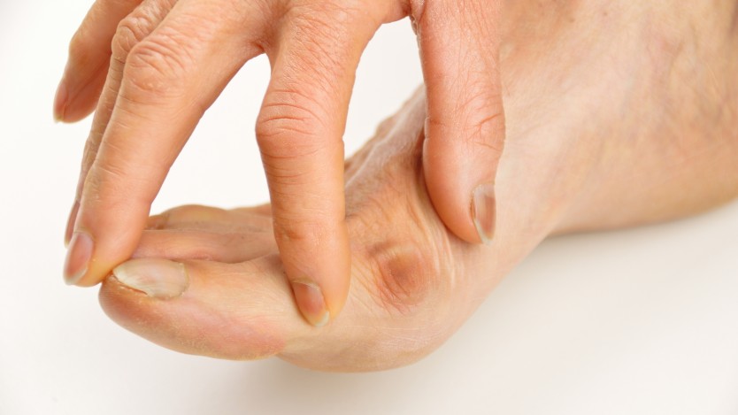 Postoperative period after hallux valgus surgery