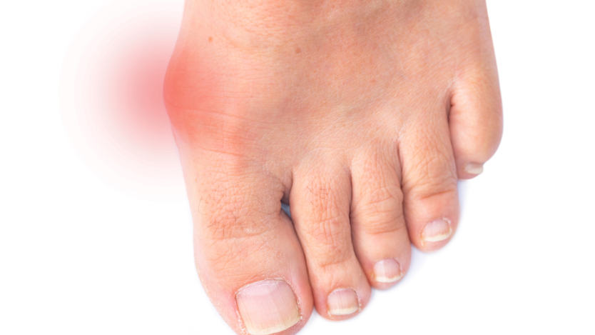 14 things to know about bunion surgery