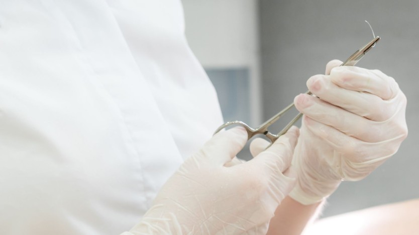 Stitches in phimosis, duration, hygiene and recommendations