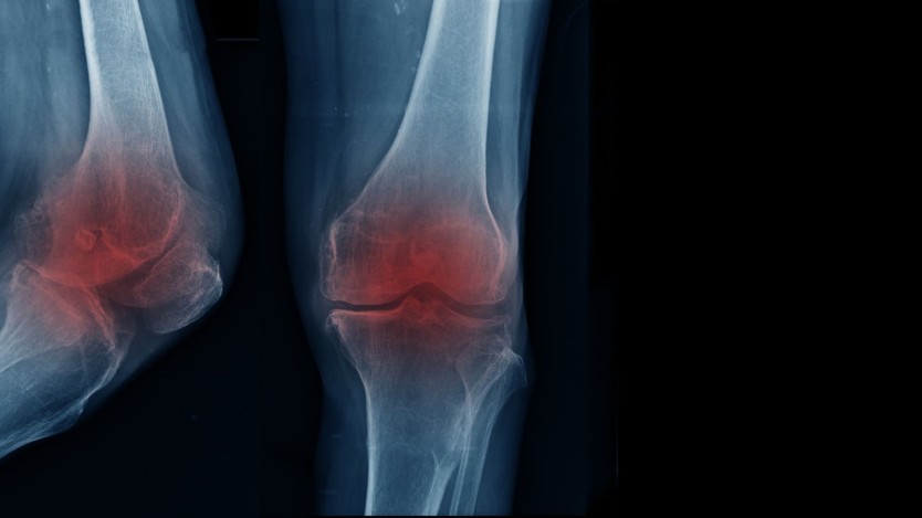 Torn Meniscus: What it is, Causes, Symptoms and Treatments