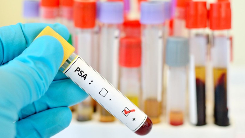 Prostate Antigen: what it is, what it detects, most serious levels