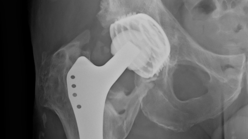 What is an arthroplasty?