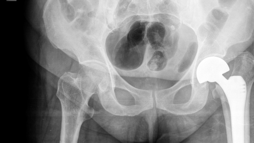 Recovery time after a hip replacement surgery