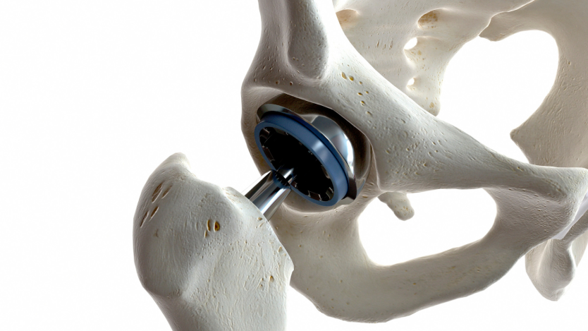 Types of hip prosthesis