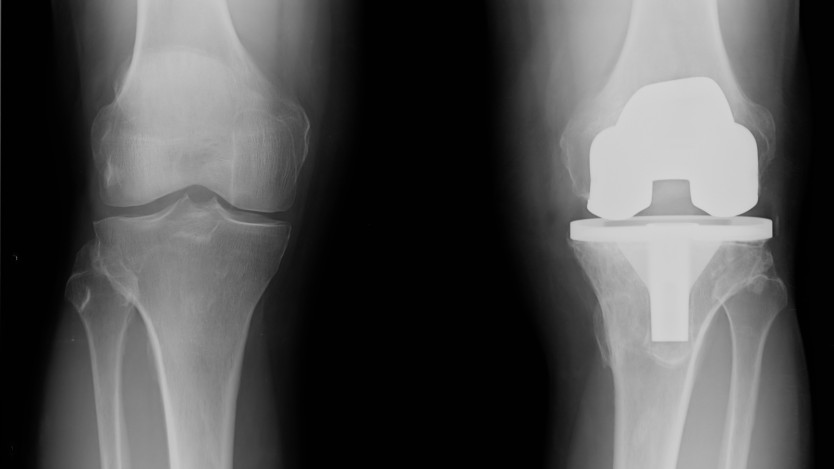 Recovery after total knee replacement surgery. Hospital stay