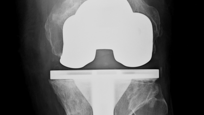 Knee prosthesis. Recovery time at home